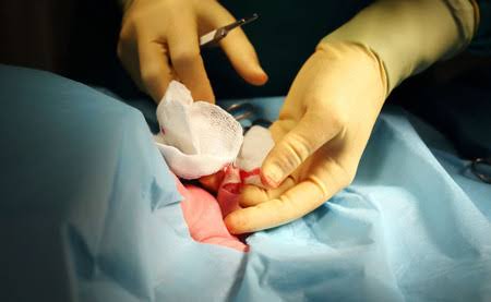 Malangnya Nasib Anak di Kuansing, Kepala Turbonya Terpotong Saat Ikut Sunat Massal